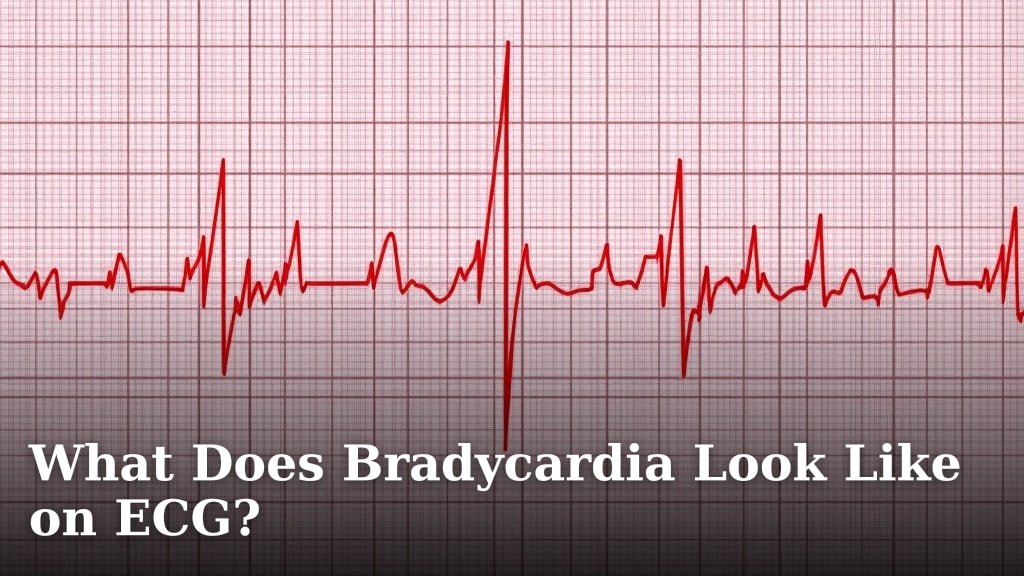 What Does Bradycardia Look Like on ECG?